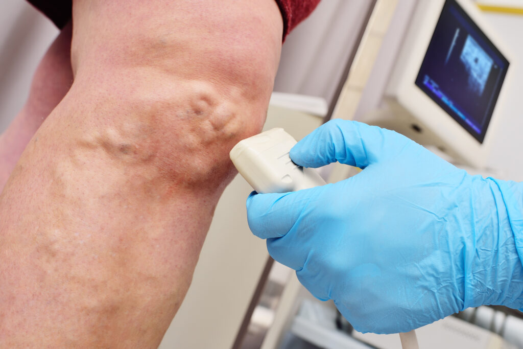 A phlebologist or vascular surgeon performs an ultrasound examination of the patient's veins.