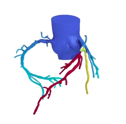 A heartflow diagnostic image