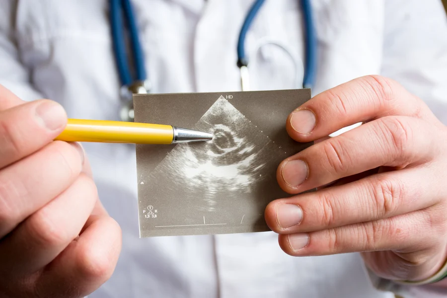 A doctor holding an ultrasound image and pointing to a potential case of aortic stenosis