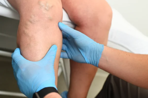 A healthcare professional wearing blue gloves is examining a person's leg with varicose veins, a common symptom of venous disease.