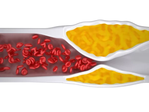 A medical illustration depicting a blood vessel partially blocked by plaque build-up, leading to a narrowed passage for blood flow and a potential risk for blood clots which can cause cardiovascular events, developed by the Cardio