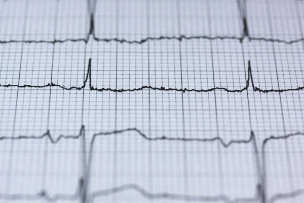 Close-up of an electrocardiogram (ekg/ecg) printout showing heart rhythm by a Cardiologist.